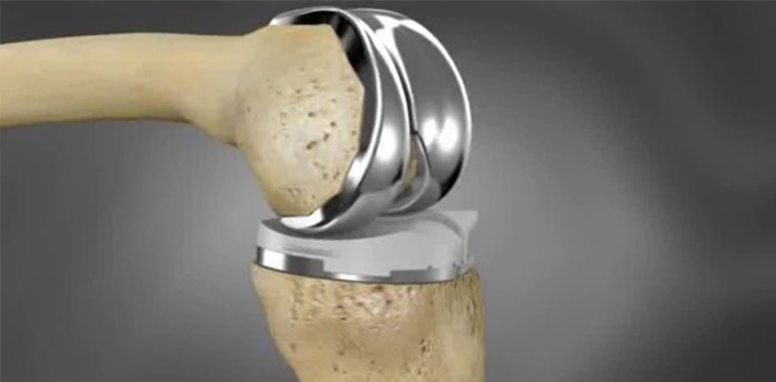 What is Knee Prosthesis? 