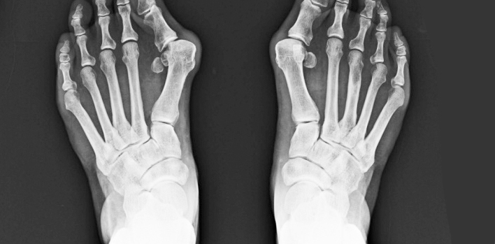 What is Halluks Valgus (Foot Finger Shape Disorder)?