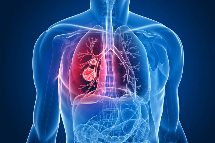 Akciğer Kanseri tedavisinde %90 başarı mümkün!