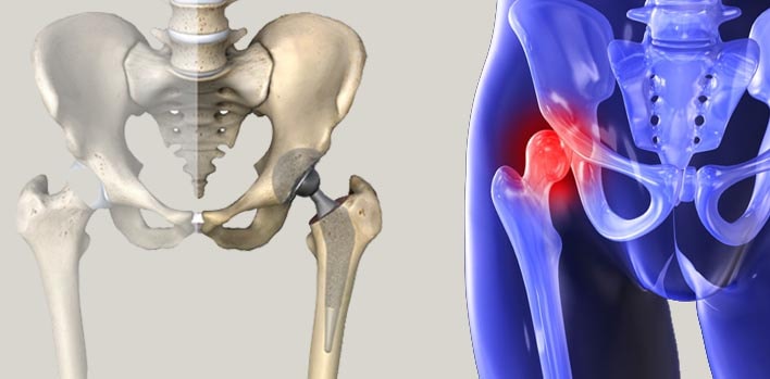 Considerations After Hip Prosthesis Surgery