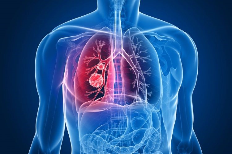 90% Success Is Possible In Lung Cancer Treatment!