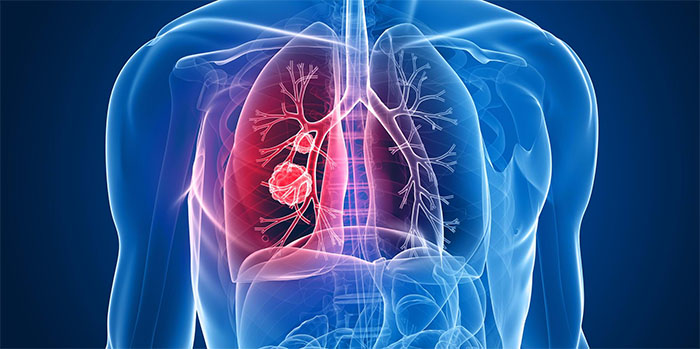 Akciğer Kanseri | Göğüs Hastalıkları