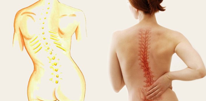 DECISION OF SCOLIOSIS TREATMENT AND TREATMENT ALTERNATIVES