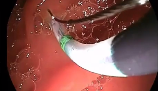 Ercp nasıl yapılır, papillotomi ve taş çıkarılması videosu - Prof. Dr. Yusuf AKCAN